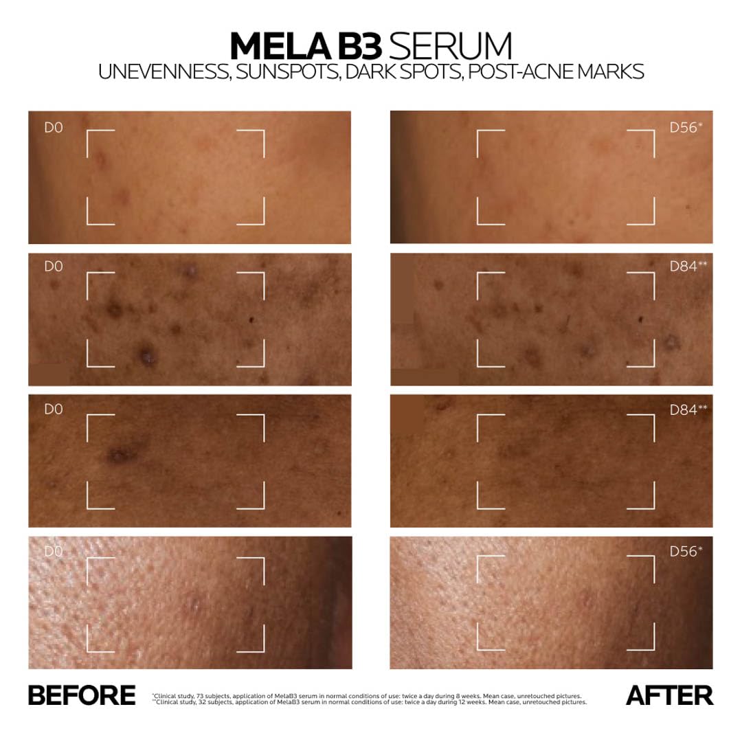La Roche-Posay Mela B3 Anti-Dark Spot Serum |Corrects Pigmentation, Sun Spots, Age Spots & Post-Acne Marks with Melasyl + 10% Niacinamide for even skin 30 ml
