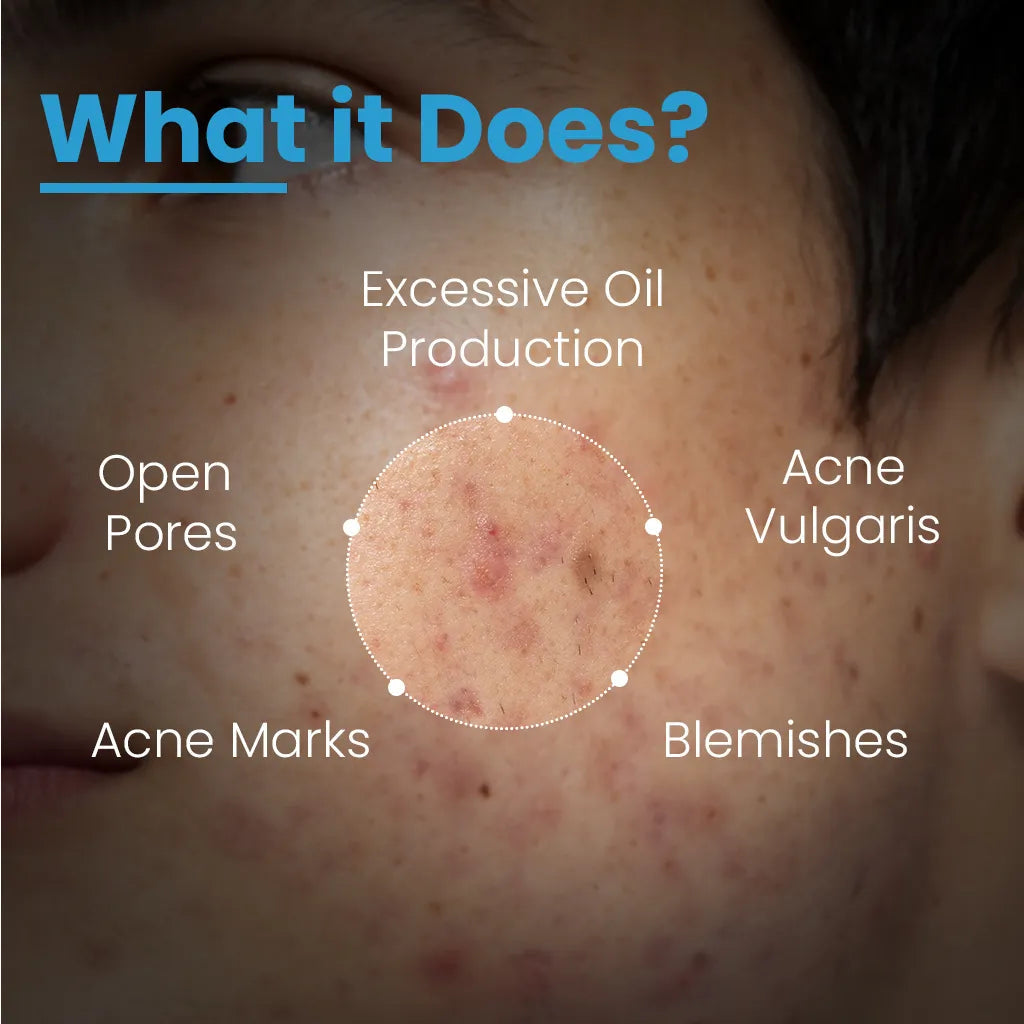 FCL Alpha Beta Acne Gel | 30 ml |  Salicylic & Glycolic Acid – Clears Breakouts & Unclogs Pores